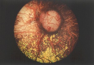 Choroidal hypoplasia                 (the light area tothe left of the optic nerve.)